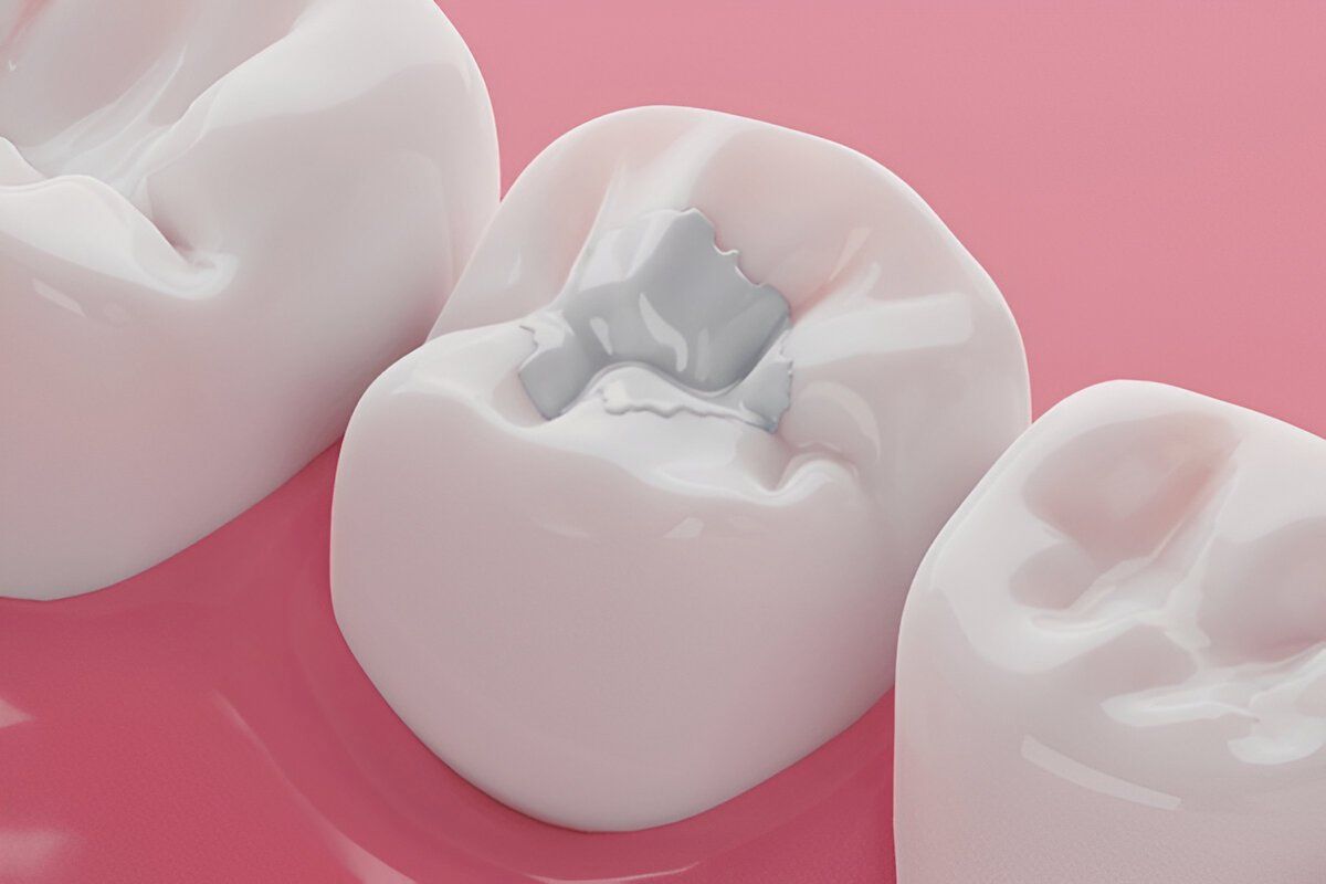 composite fillings near you